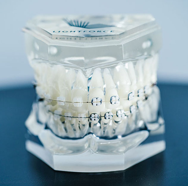 What are LightForce™ braces?